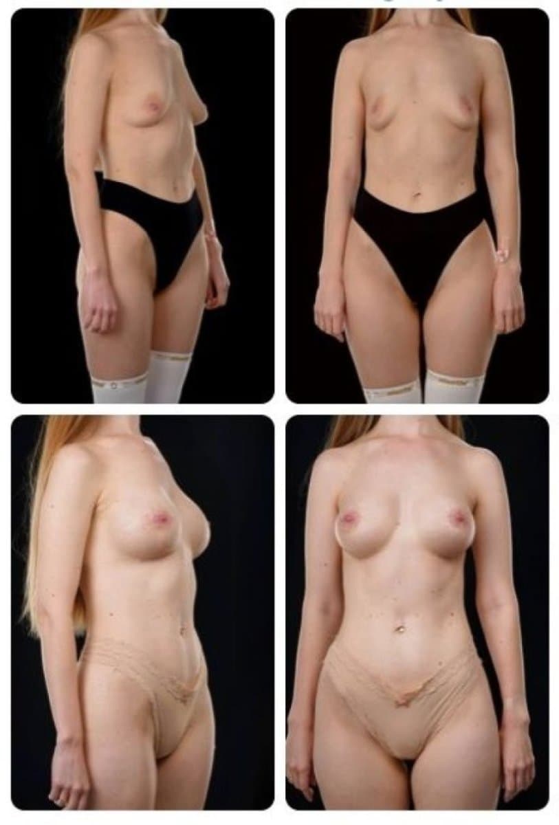 breast augmentation