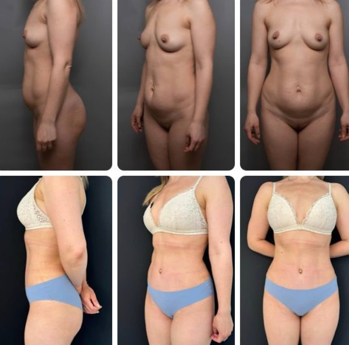 liposuction