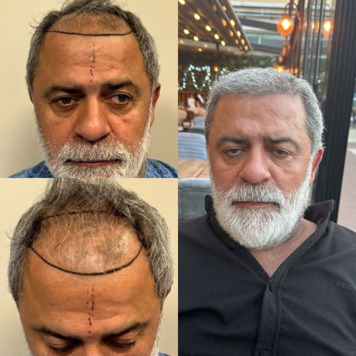 FUE hair transplant
