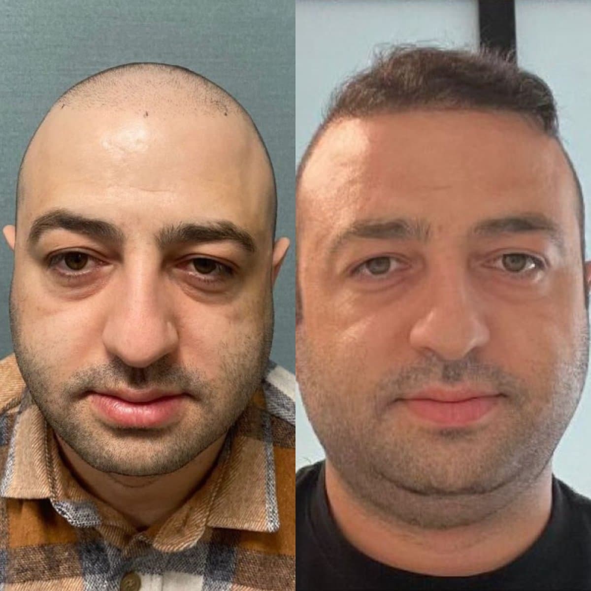 FUE hair transplant