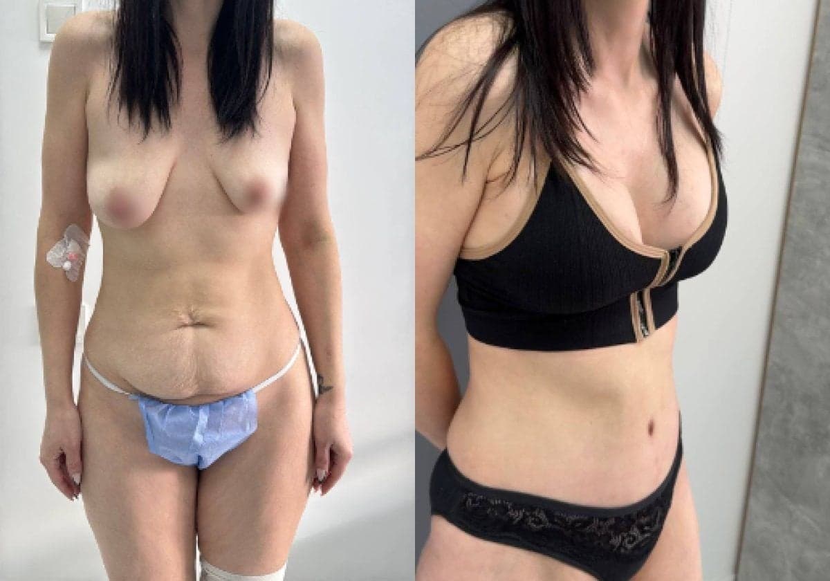 mammoplasty