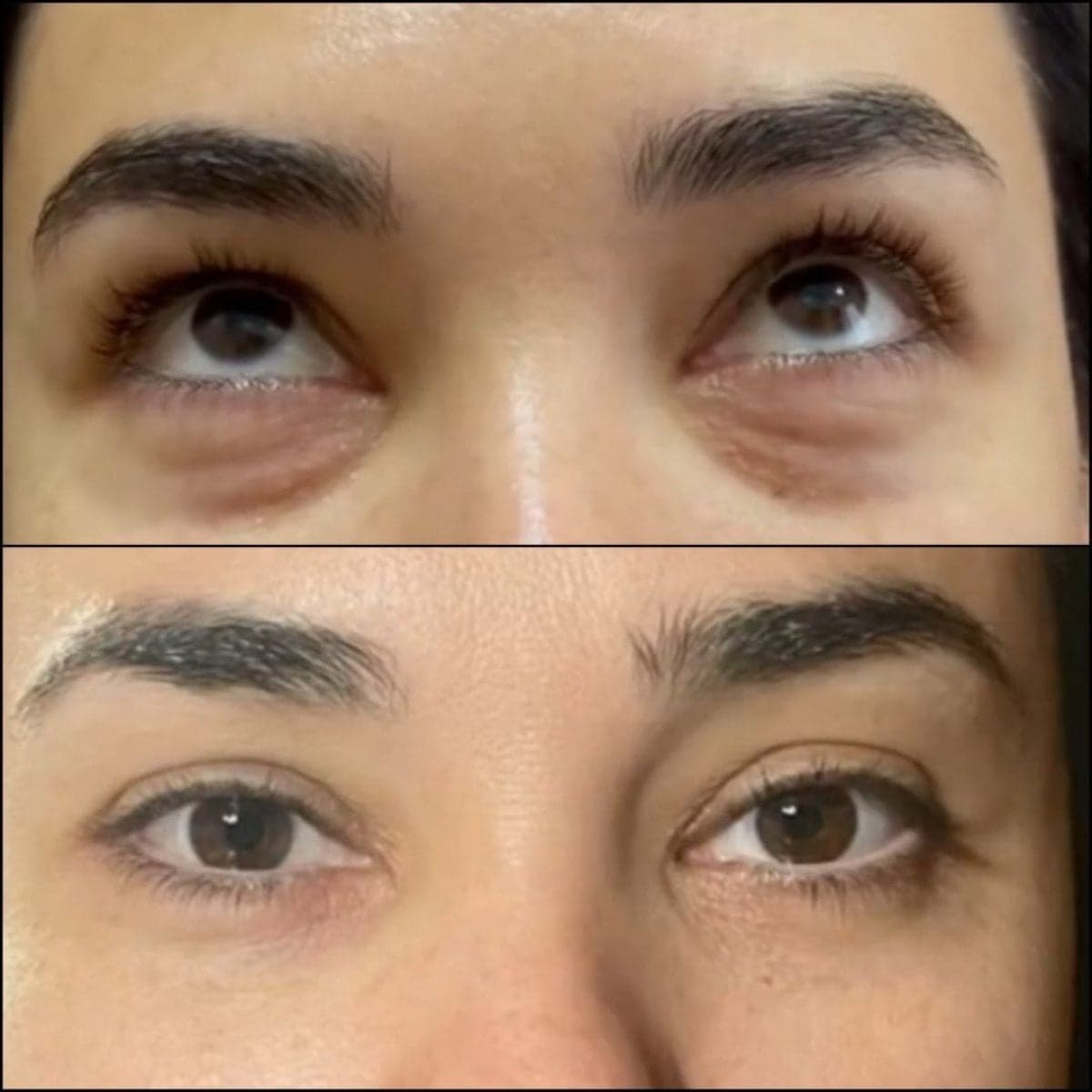 upper eyelid surgery