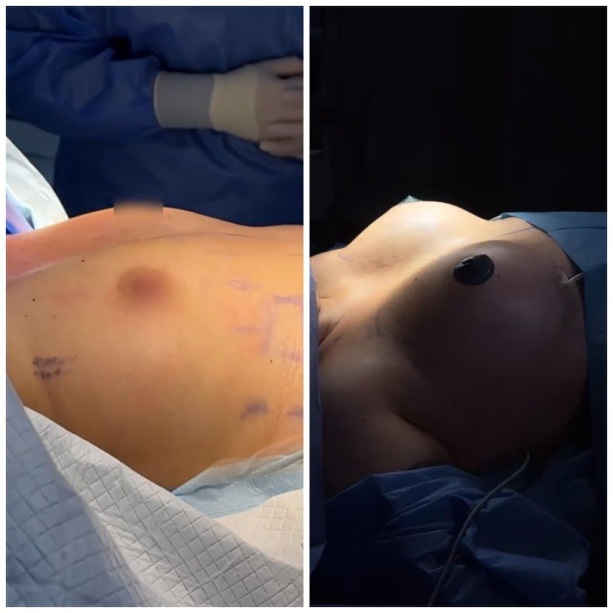 breast lift
