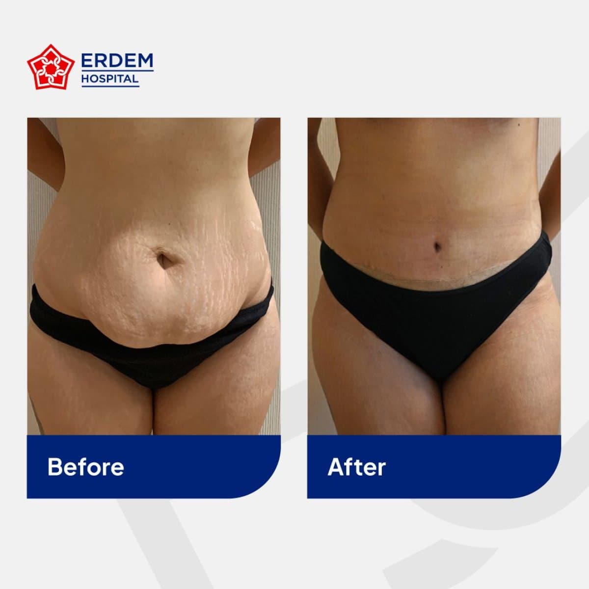 tummy tuck and liposuction