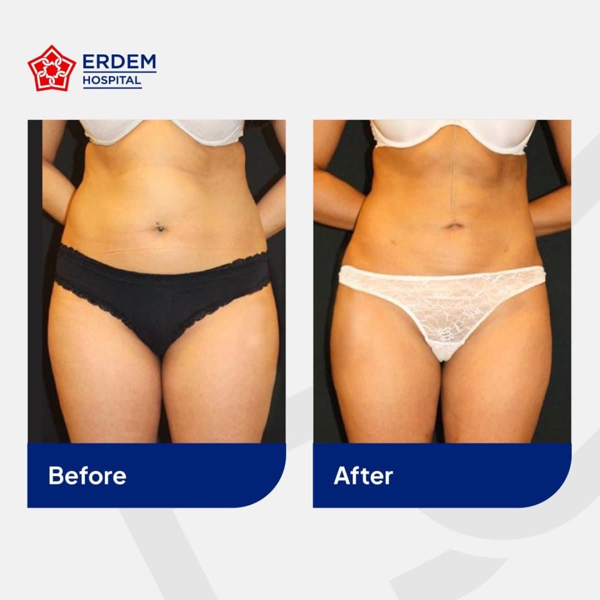 tummy tuck and liposuction
