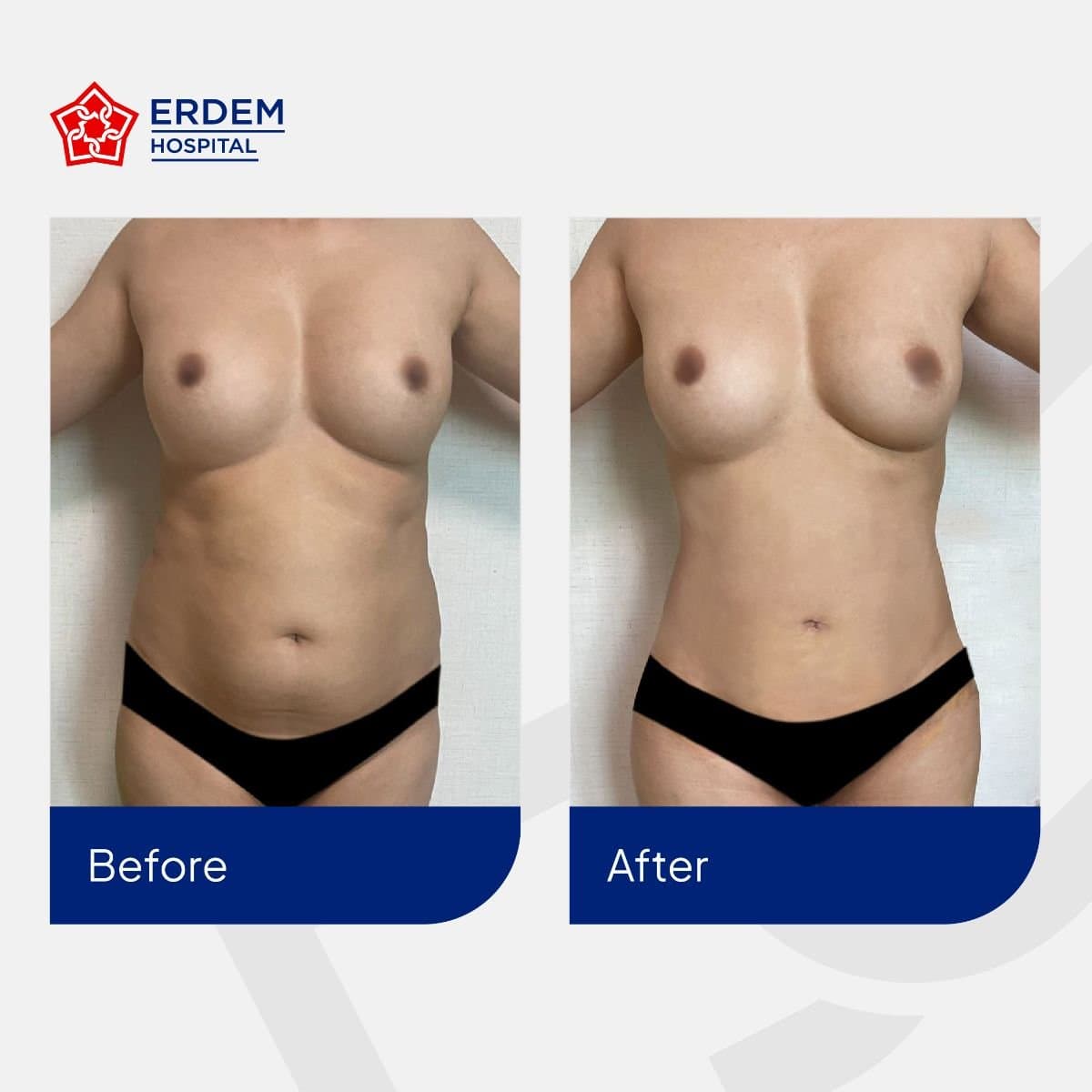 tummy tuck and liposuction
