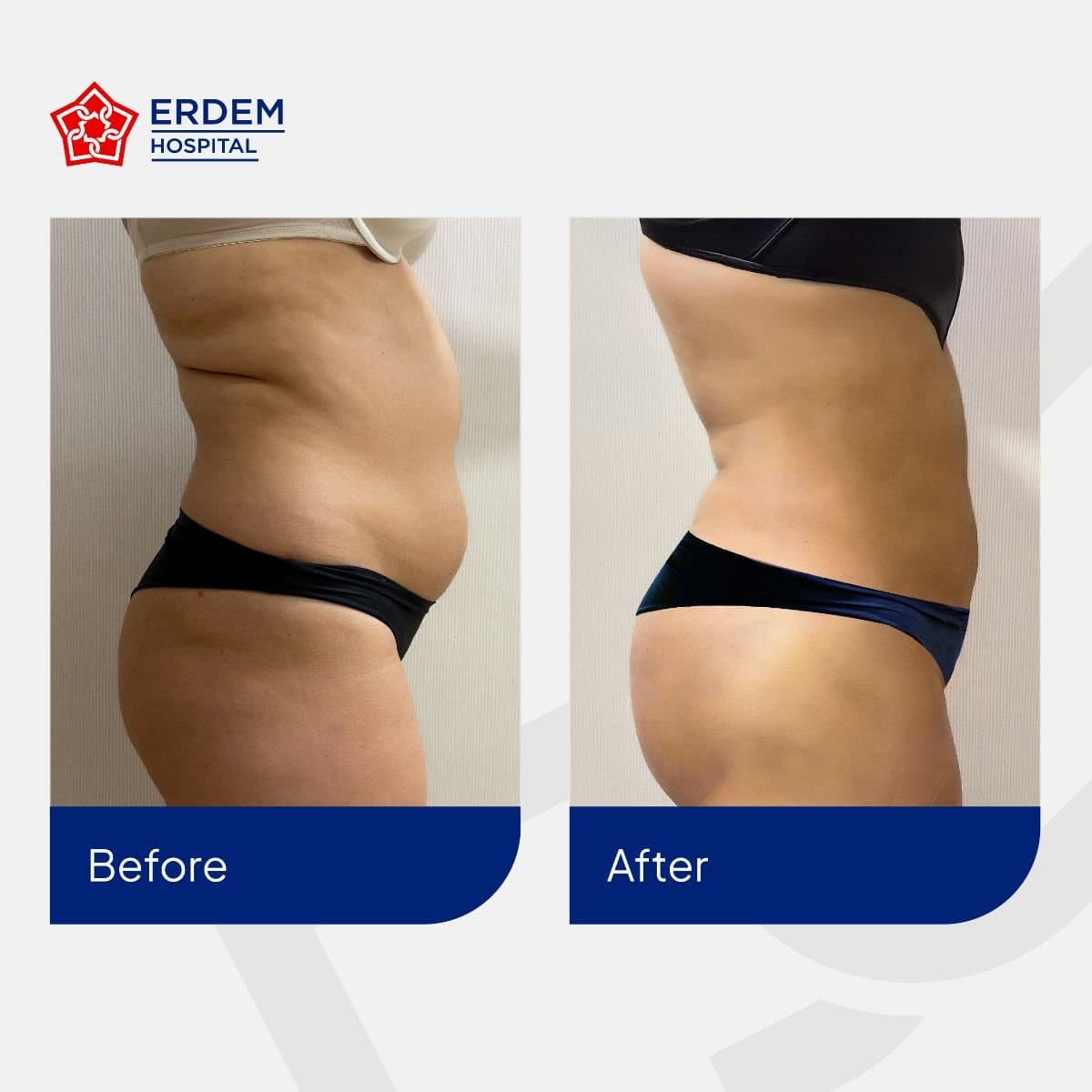 tummy tuck and liposuction