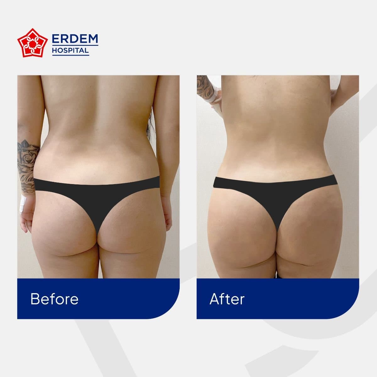Brazilian Butt Lift