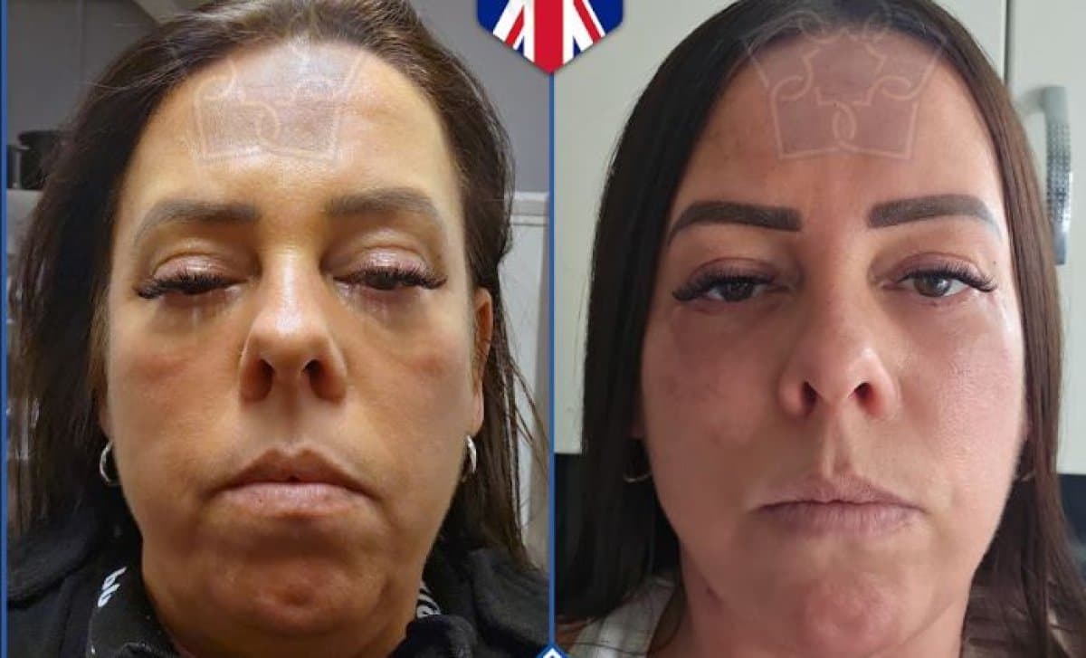 blepharoplasty