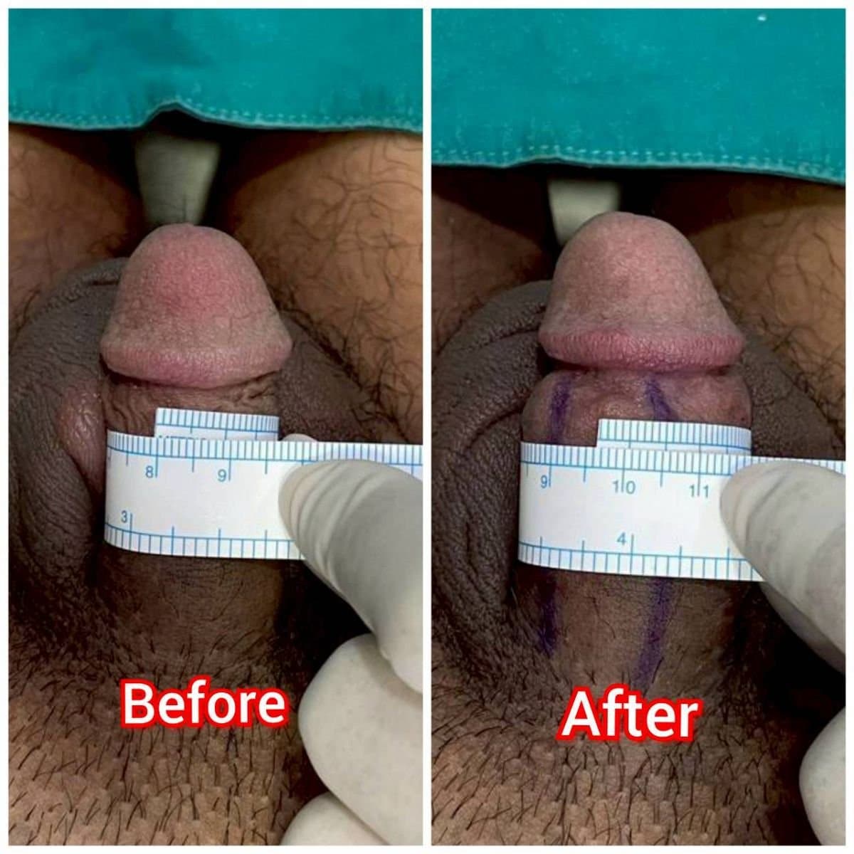 penile curvature correction