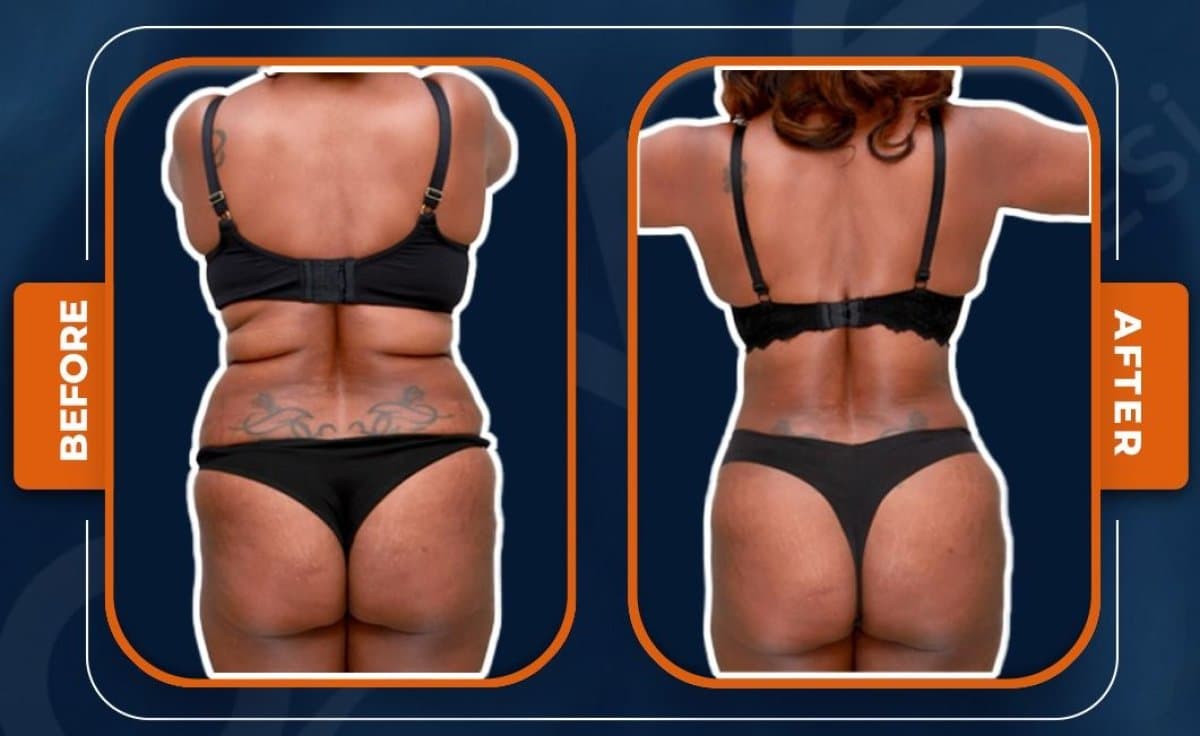 liposuction