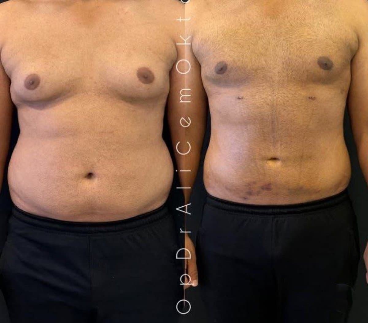 liposuction