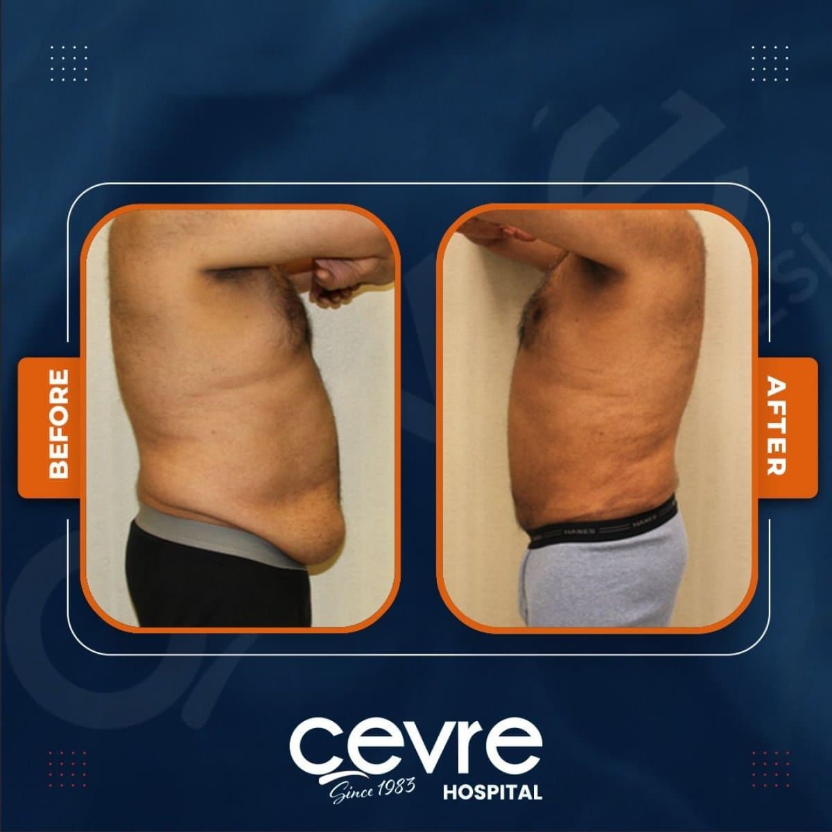 tummy tuck and liposuction