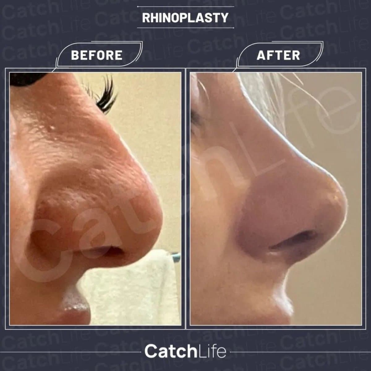 rhinoplasty