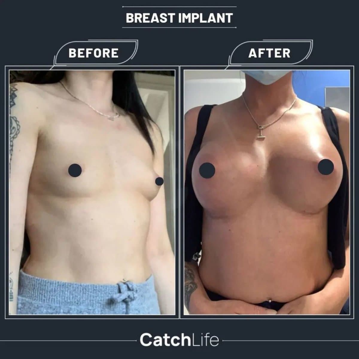 breast implants with lift