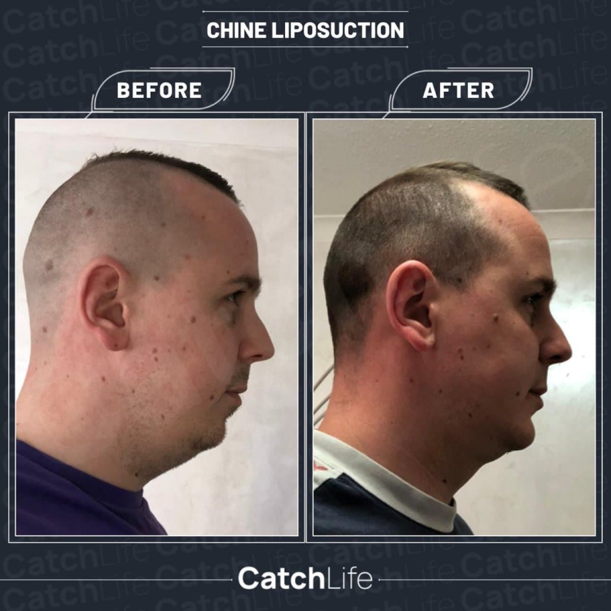 chin liposuction
