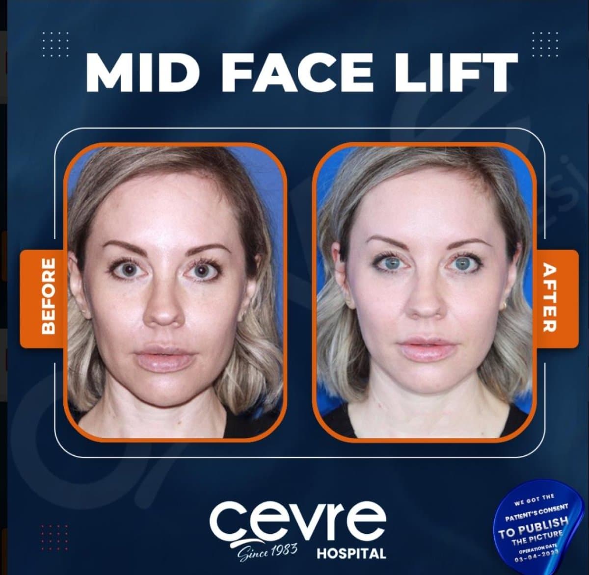facelift