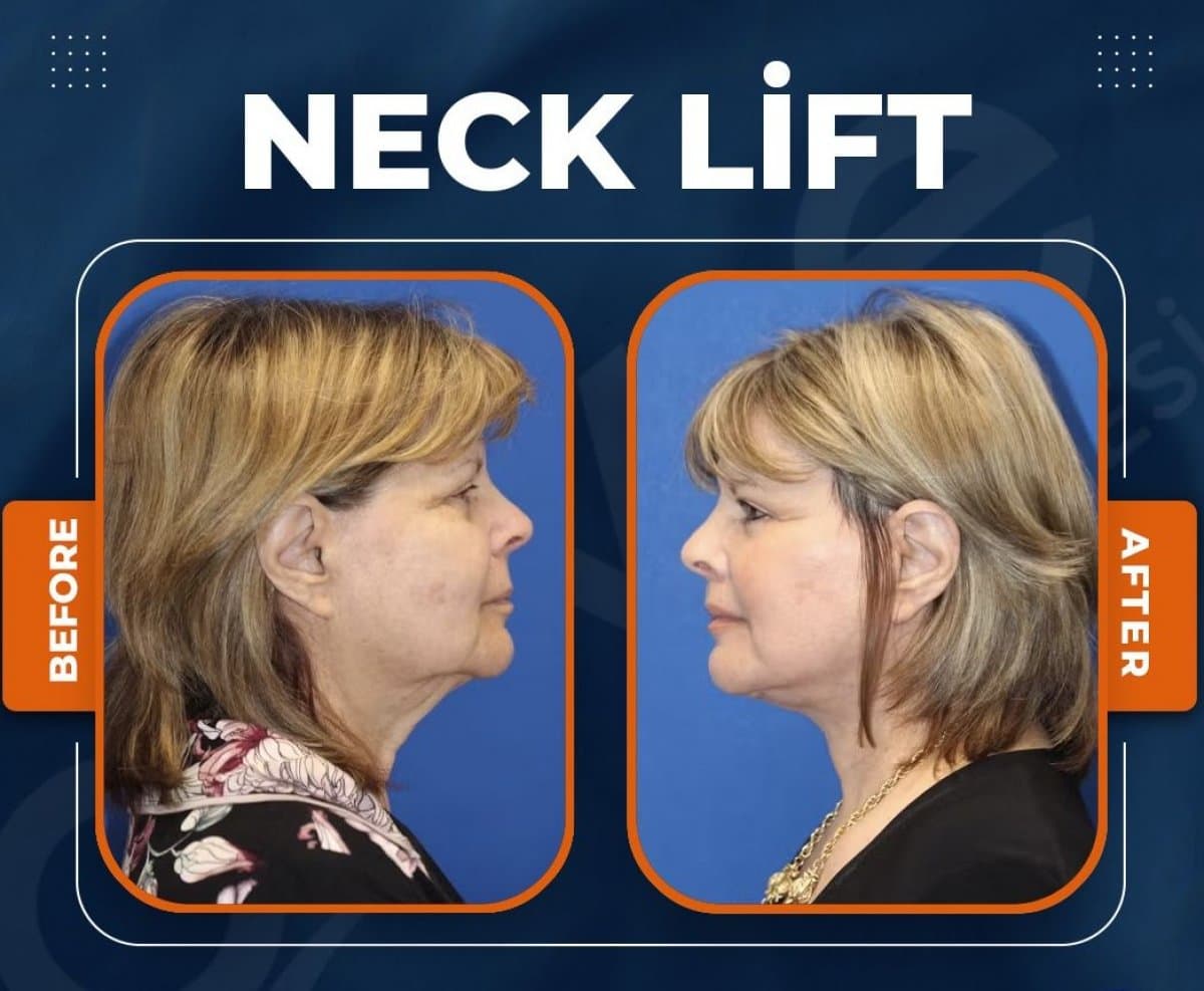 neck lift