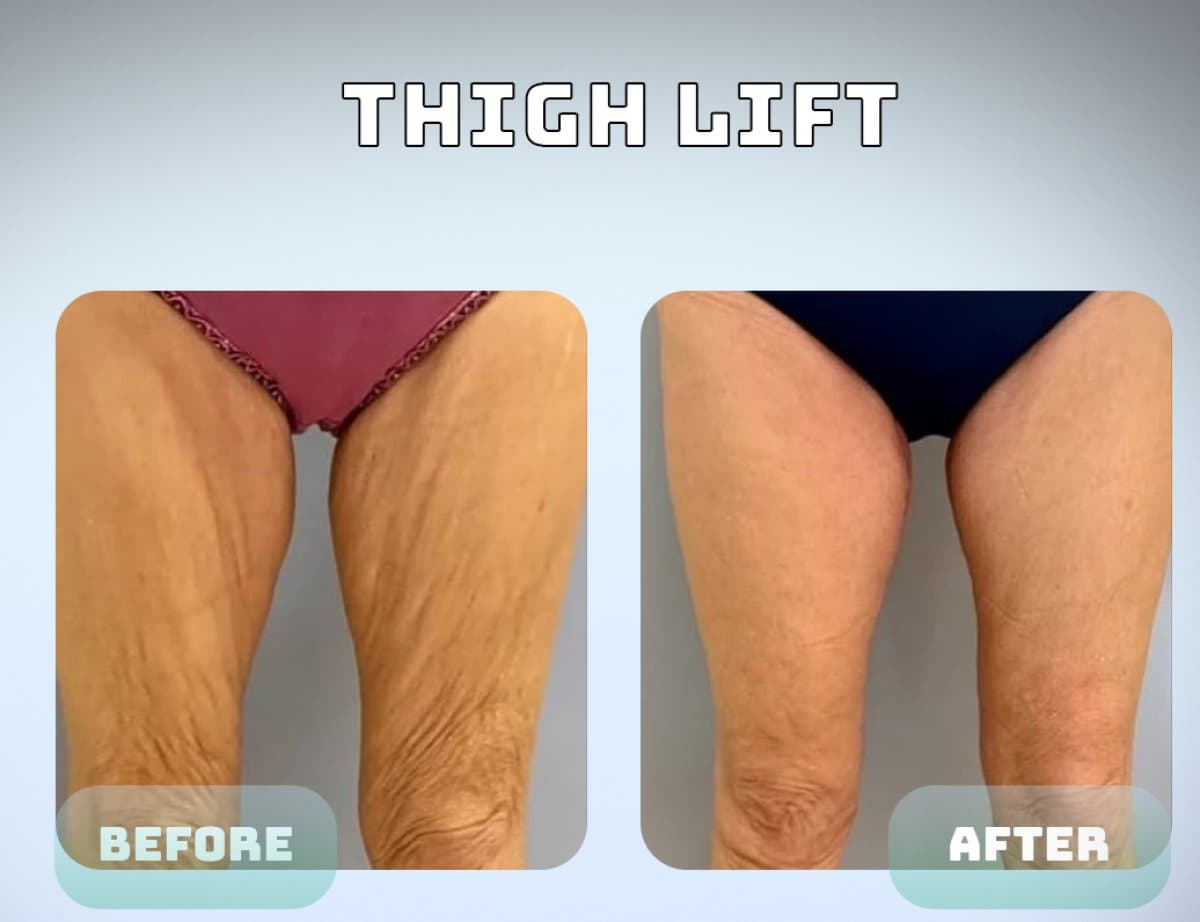 thigh lift