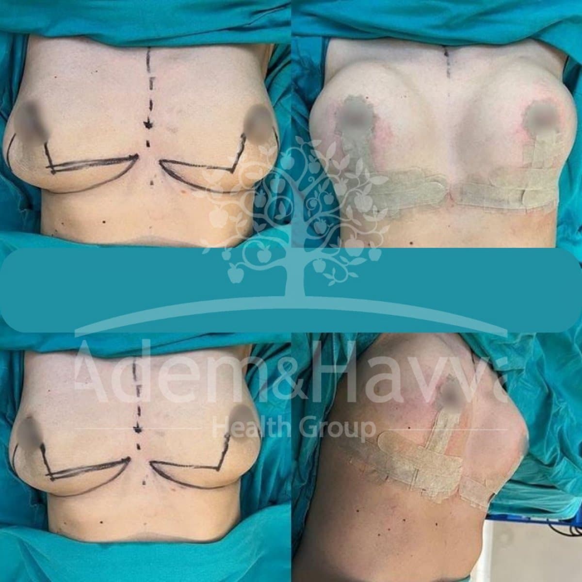 breast lift