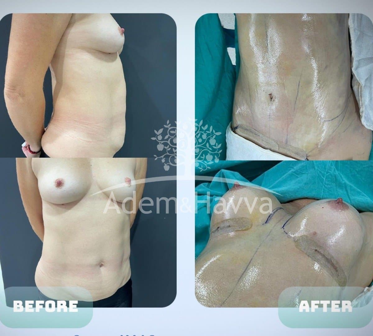 breast implants with lift