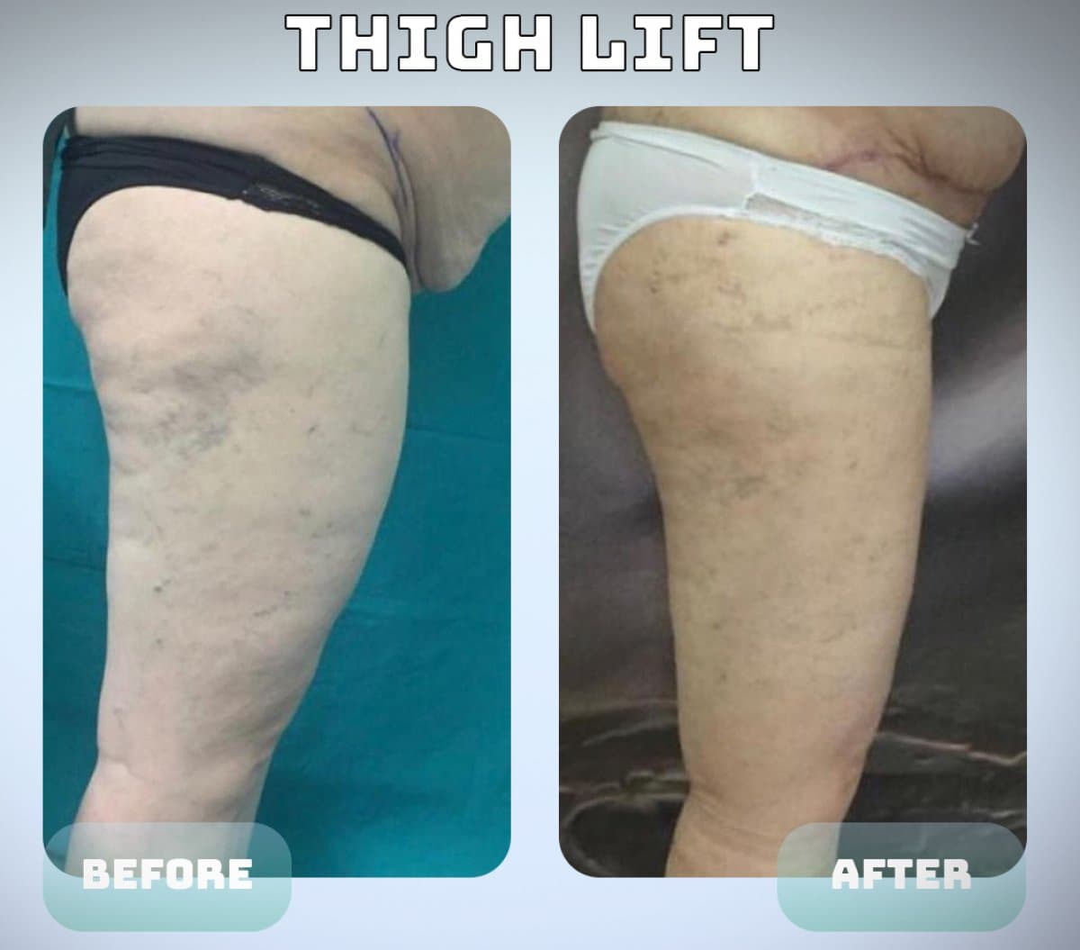 thigh lift