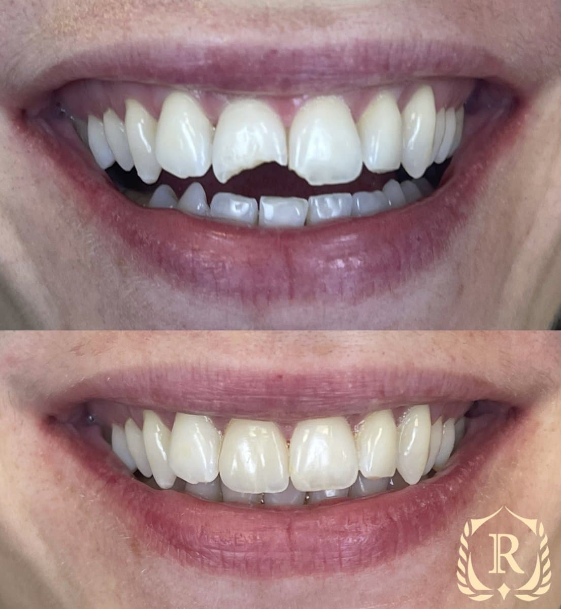 smile makeover