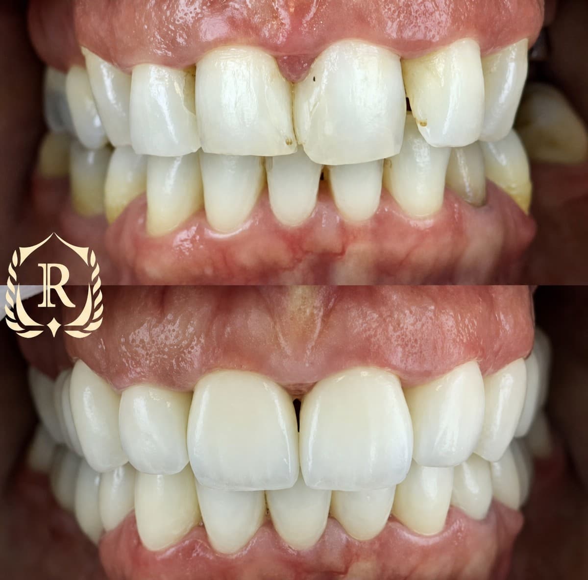 smile makeover