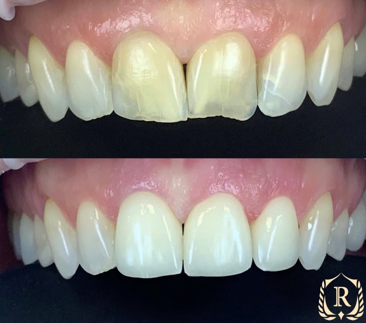smile makeover