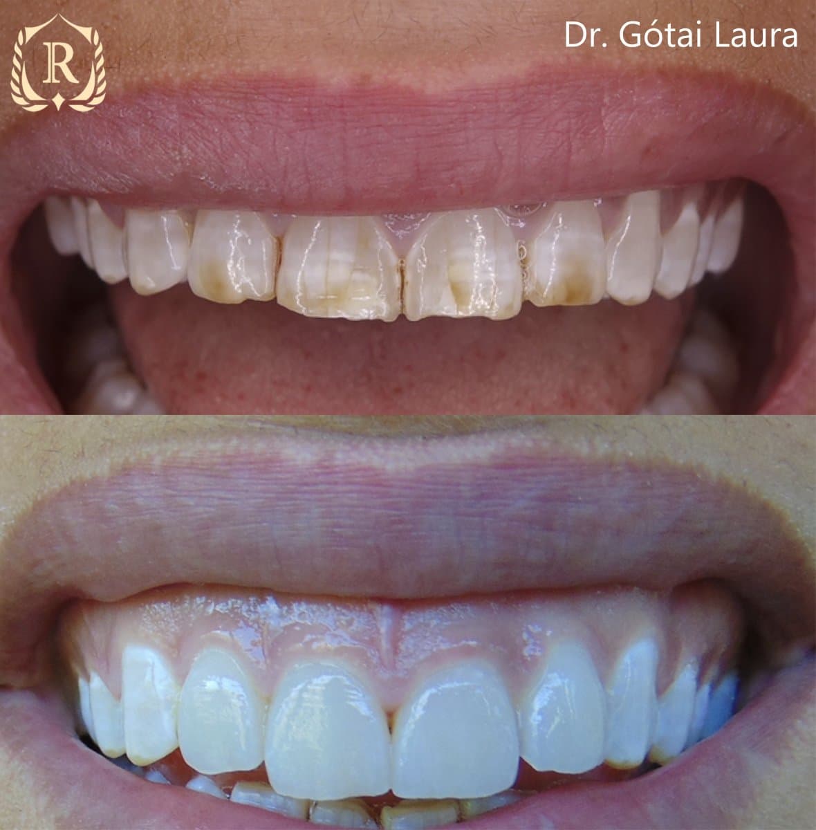smile makeover