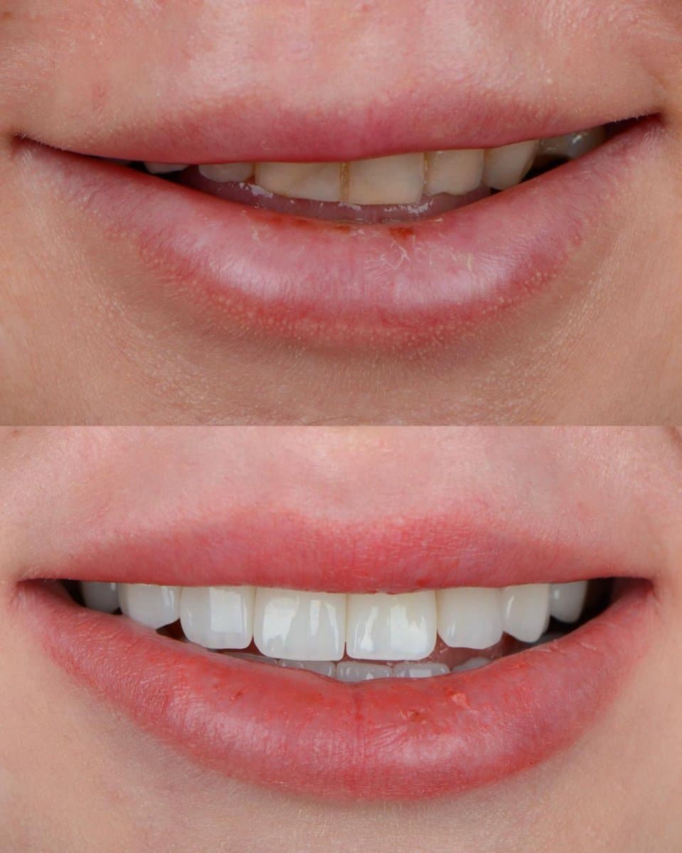 veneers