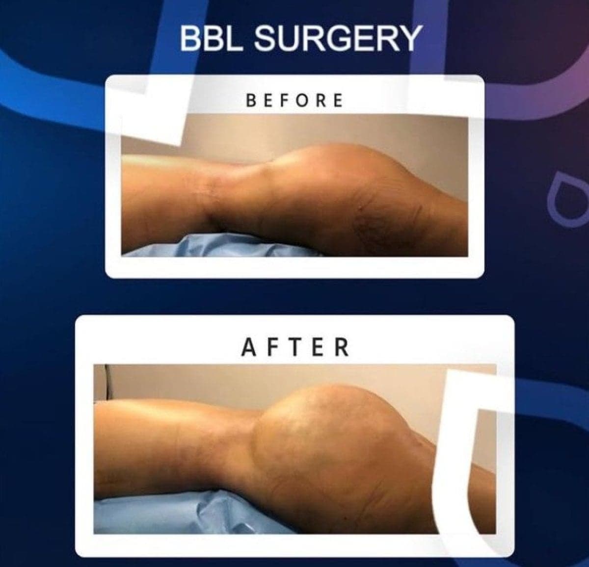 BBL surgery
