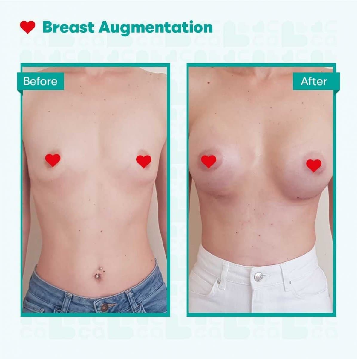 breast augmentation