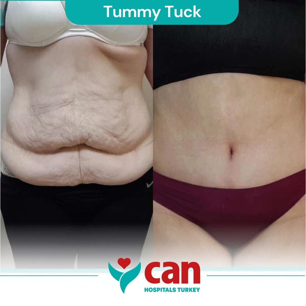 tummy tuck