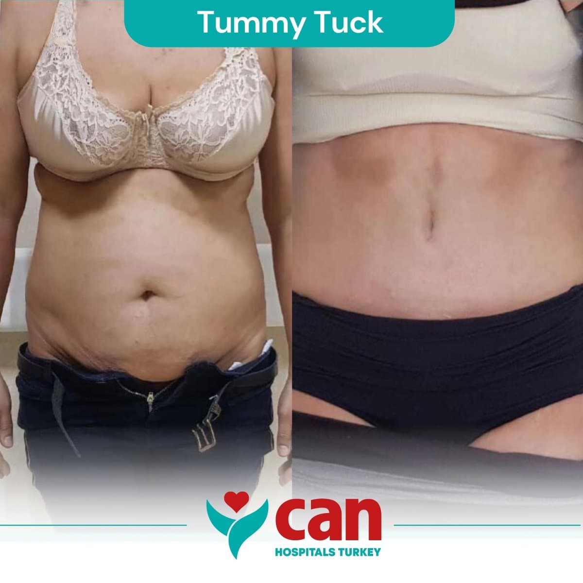 tummy tuck