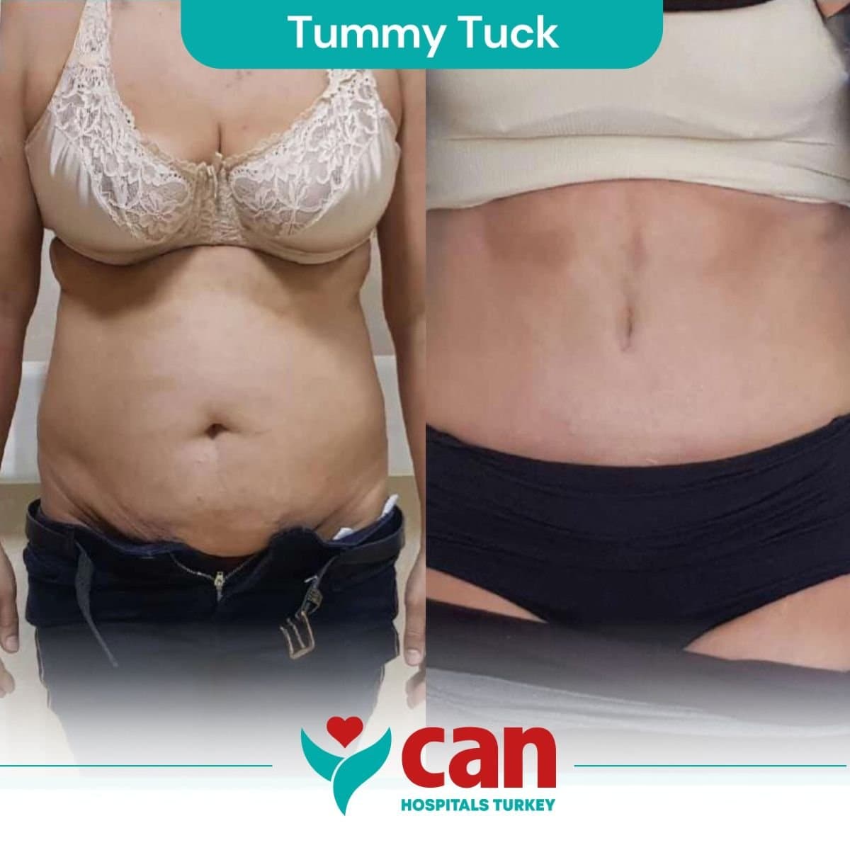 tummy tuck