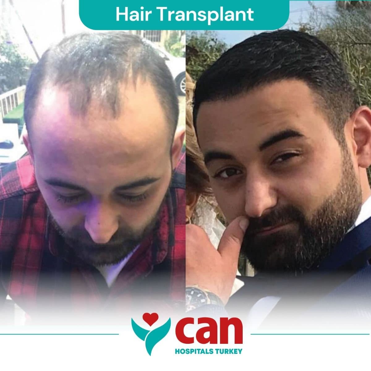 hair transplant