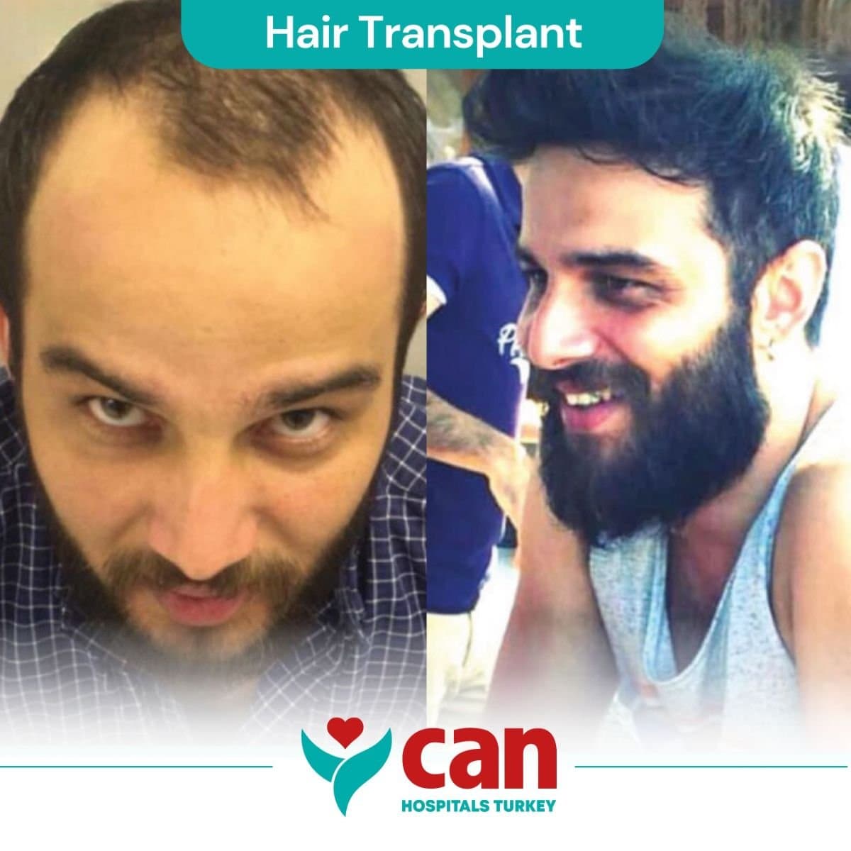 hair transplant