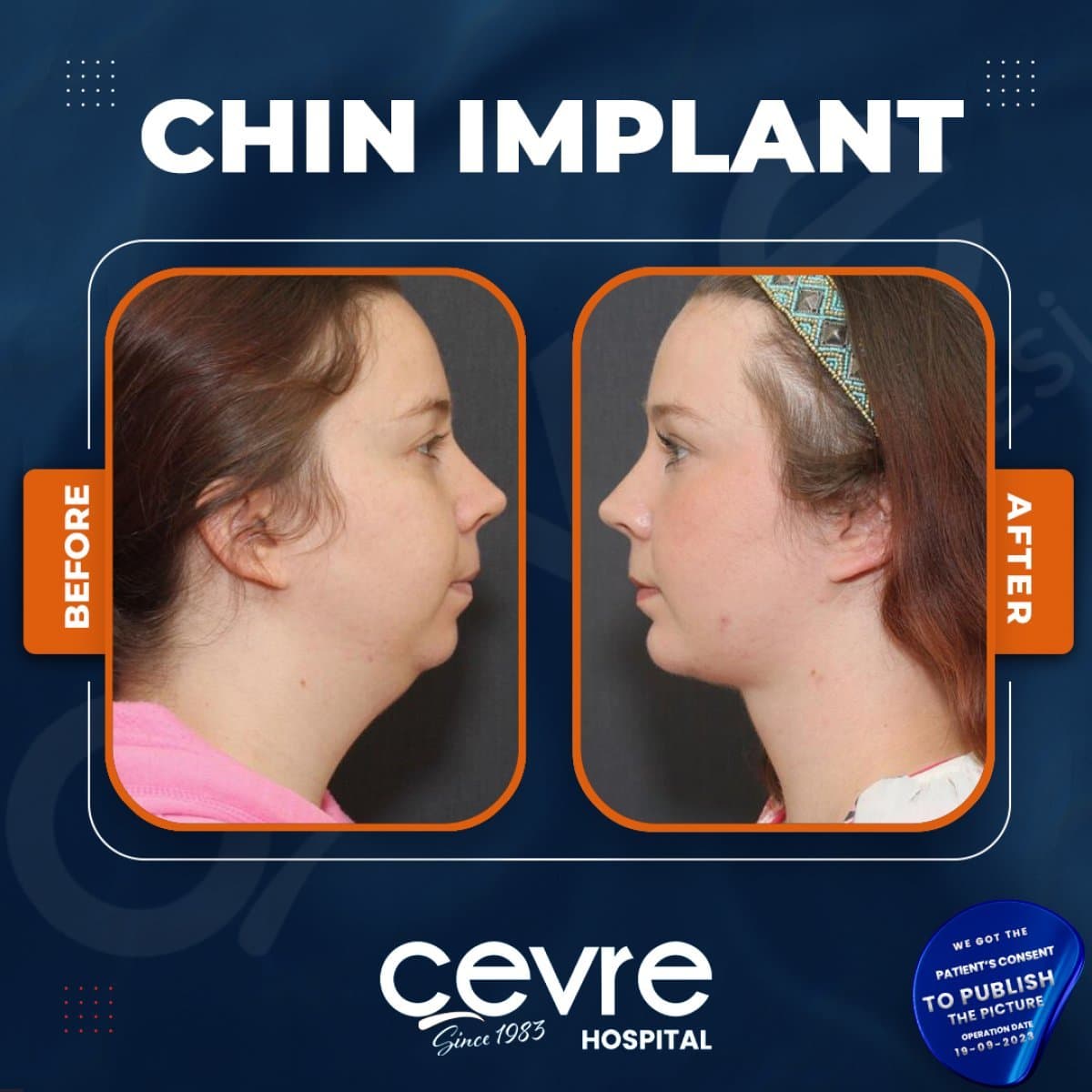 chin implant