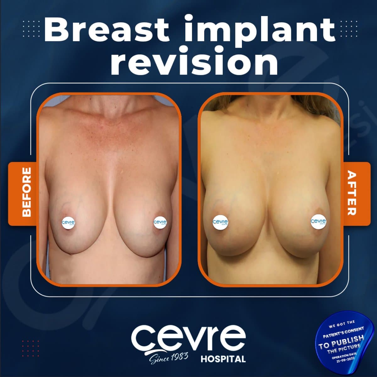 breast implant revision