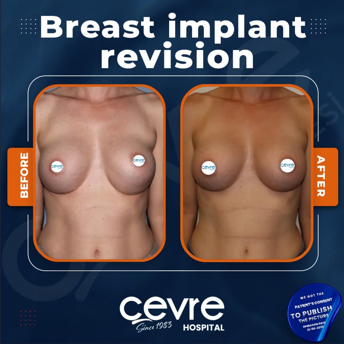 breast implant revision
