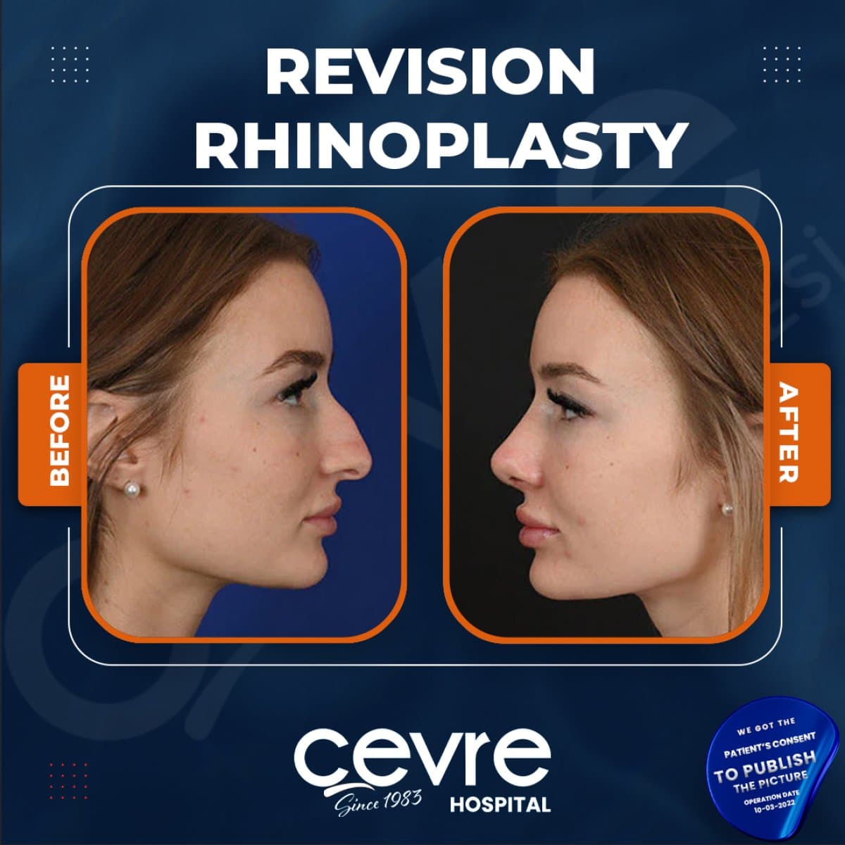 revision rhinoplasty