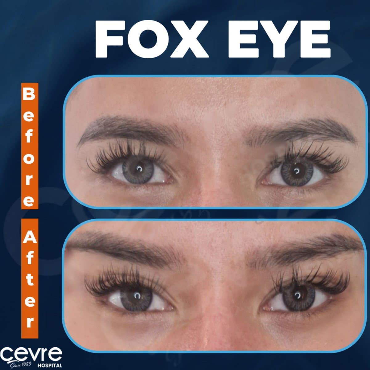 fox eye lift