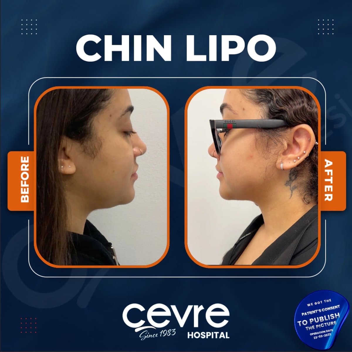 chin liposuction