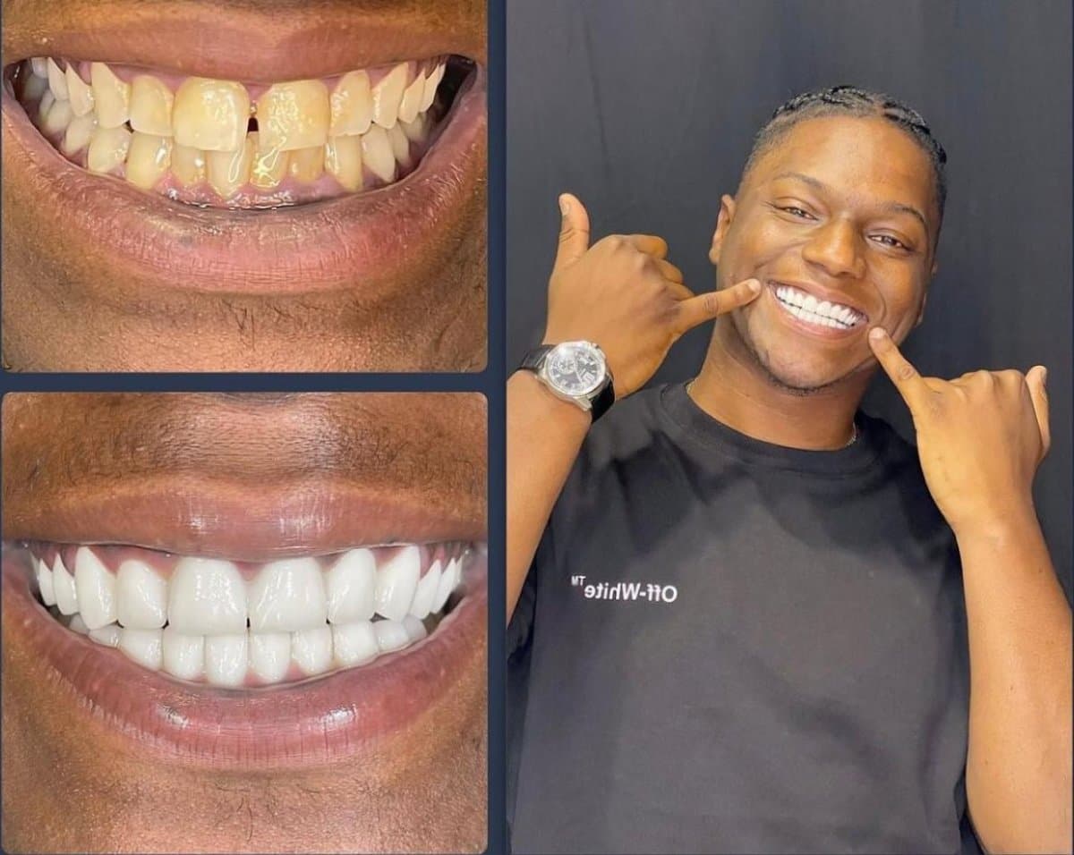 mini dental implant