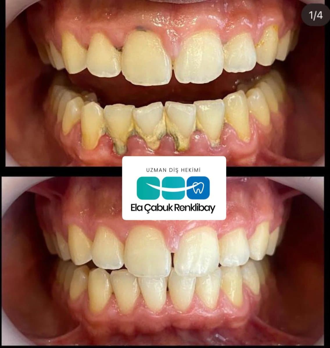 gingivectomy