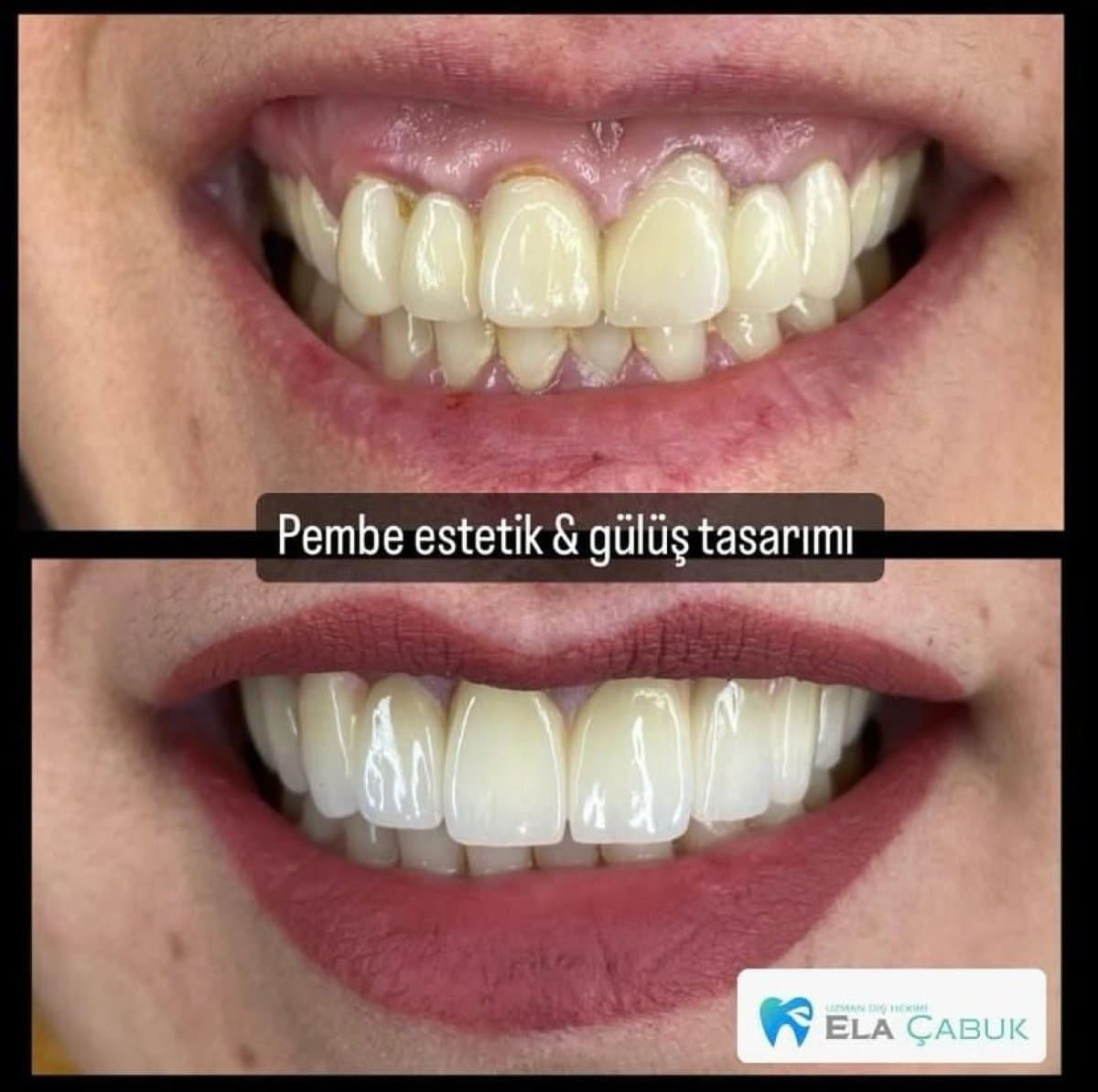 gingivectomy