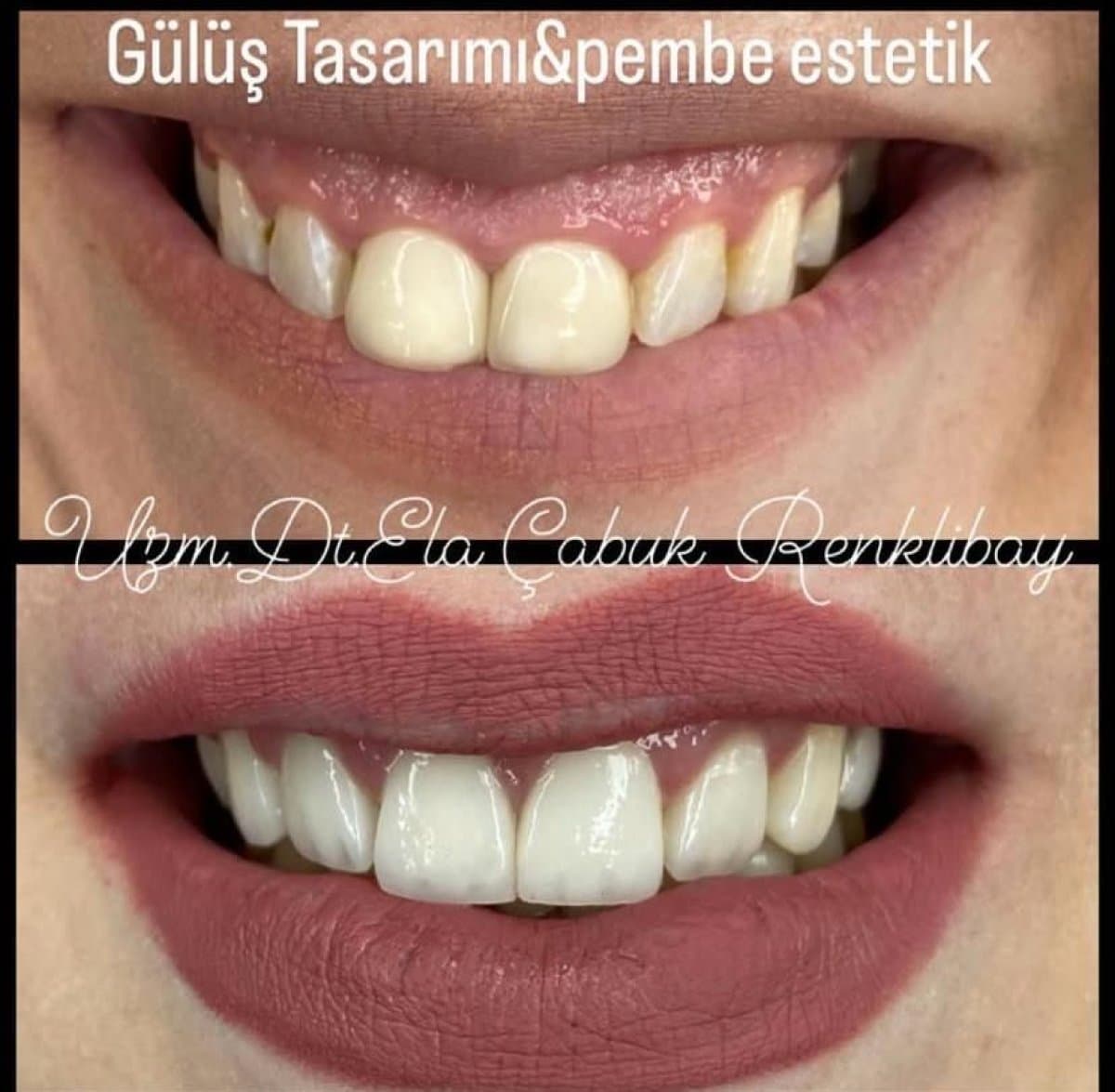 gingivectomy