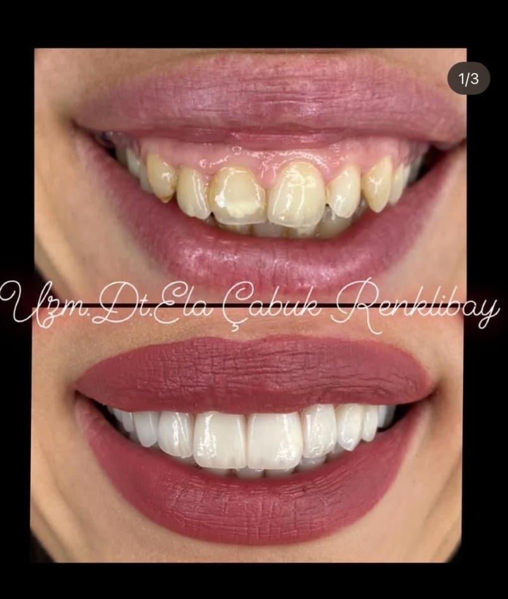 crown lengthening