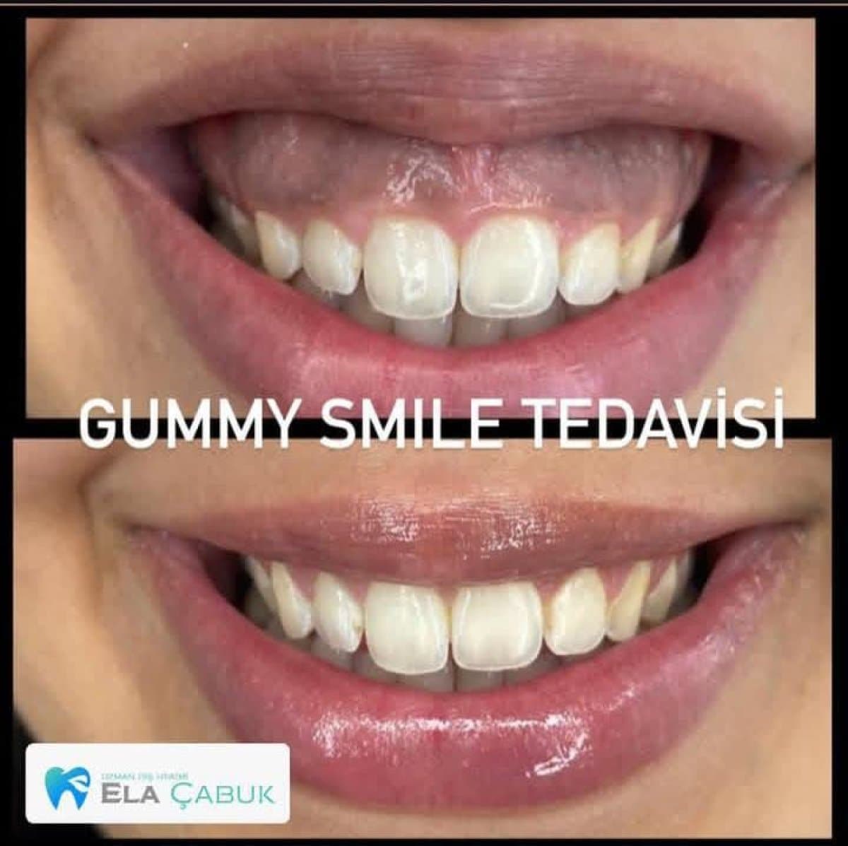 gingivectomy